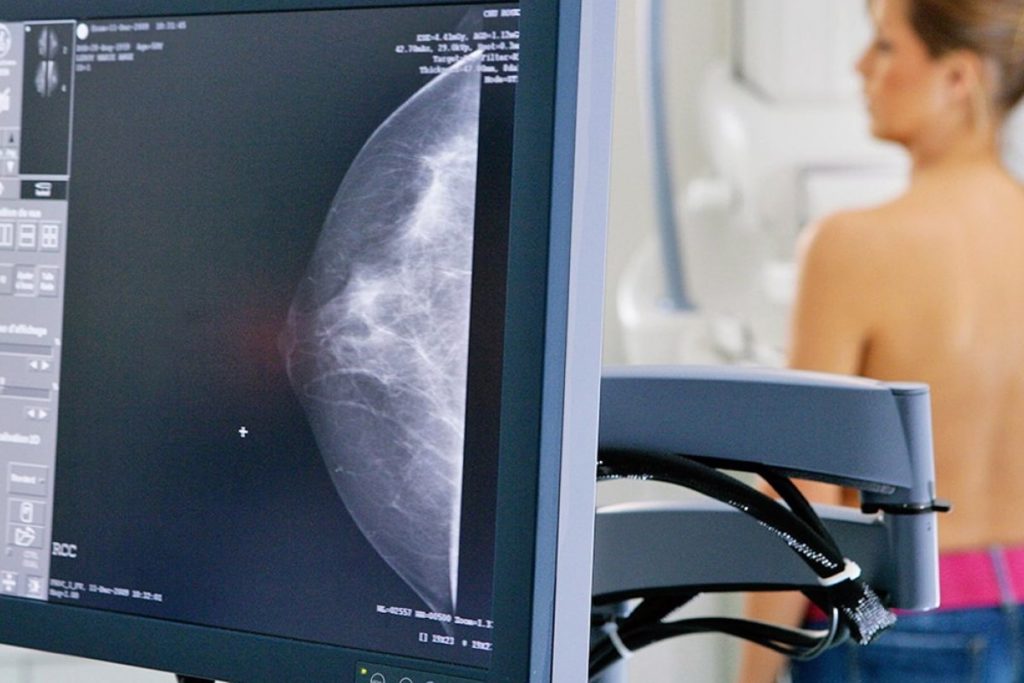 Cientos de mujeres accederán a mamografías gratuitas en Capital y La Banda
