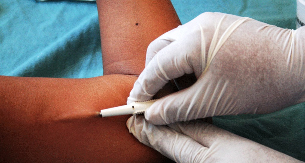 Colocarán implantes subdérmicos en el barrio Ampliación Tabla Redonda