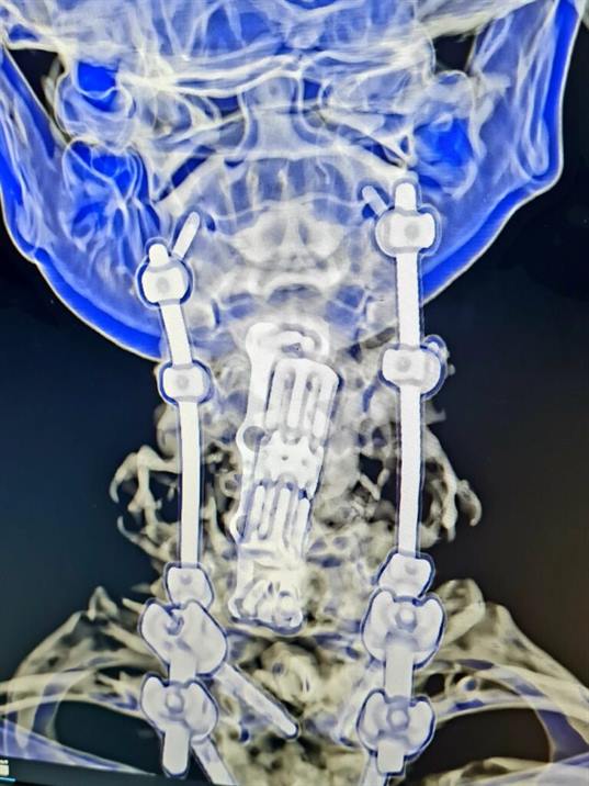 Innovadora cirugía se realizó con éxito en el hospital Regional